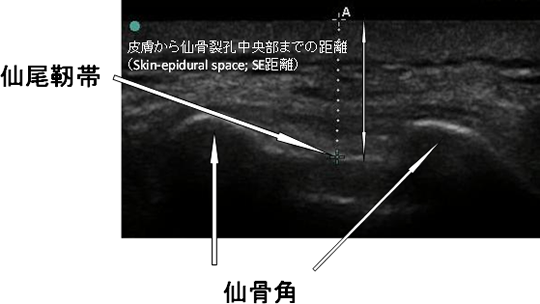 図:仙骨裂孔の超音波検査画像
