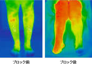 図：ブロックを行う前後のサーモグラフィ検査の画像